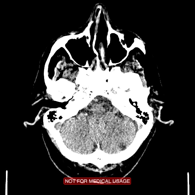 Artery of Percheron infarction (Radiopaedia 28679-28967 Axial non-contrast 24).jpg
