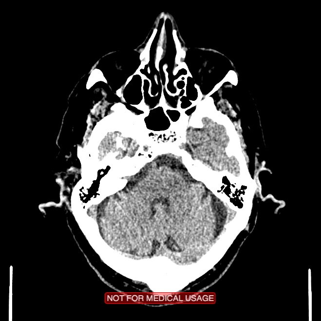 Artery of Percheron infarction (Radiopaedia 28679-28967 Axial non-contrast 30).jpg