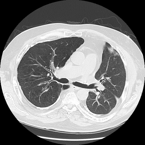 Asbestos-related pleural disease (Radiopaedia 74366-85250 Axial lung window 54).jpg
