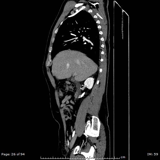 File:Ascending aortic aneurysm (Radiopaedia 50086-55404 C 19).jpg
