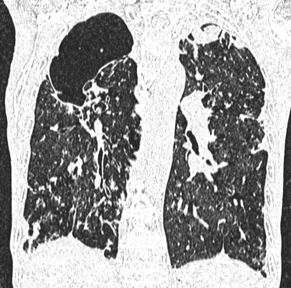 Aspergilloma- with Monod sign (Radiopaedia 44737-48532 Coronal lung window 300).jpg