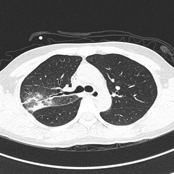 Aspergilloma (Radiopaedia 26223-26347 Axial lung window 28).jpg