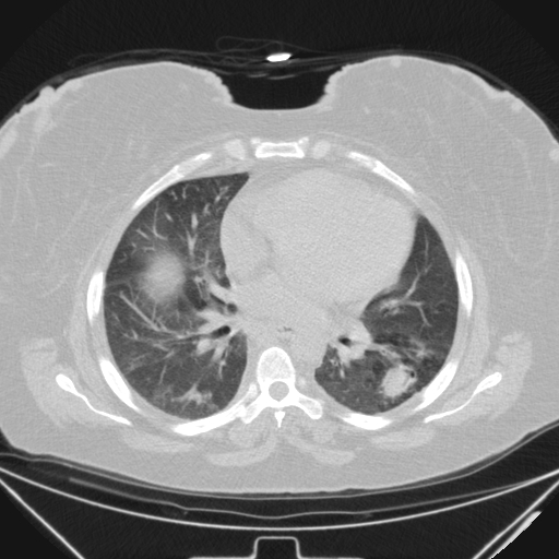 Aspergilloma (Radiopaedia 39611-41932 Axial lung window 70).jpg