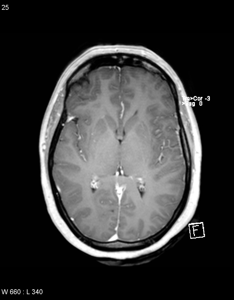 Astroblastoma (Radiopaedia 39792-42218 Axial T1 C+ 24).jpg