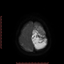 Astroblastoma (Radiopaedia 74287-85162 Axial DWI 96).jpg