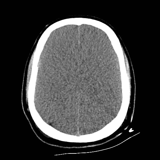 File:Atlanto-occipital dislocation (Radiopaedia 44648-48412 Axial non-contrast 39).jpg