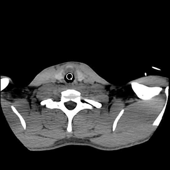 File:Atlanto-occipital dissociation (Traynelis type 1), C2 teardrop fracture, C6-7 facet joint dislocation (Radiopaedia 87655-104061 Axial non-contrast 74).jpg