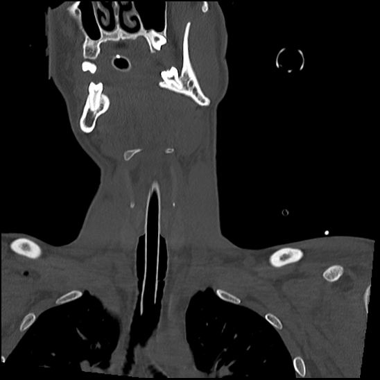 Atlanto-occipital dissociation (Traynelis type 1), C2 teardrop fracture, C6-7 facet joint dislocation (Radiopaedia 87655-104061 Coronal bone window 20).jpg