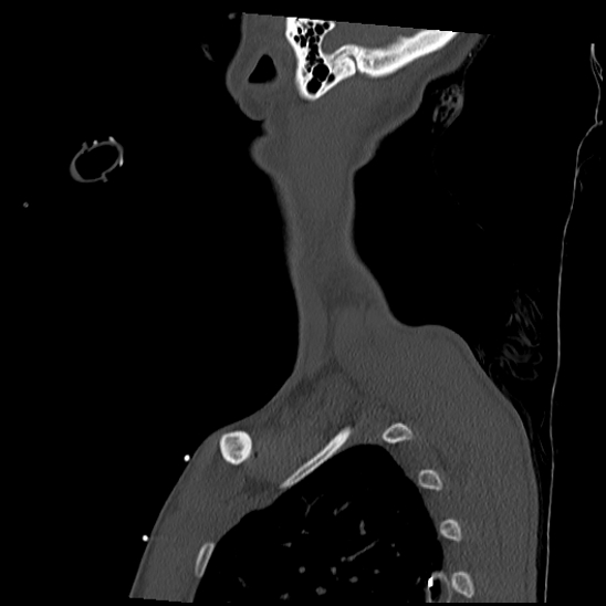 File:Atlanto-occipital dissociation (Traynelis type 1), C2 teardrop fracture, C6-7 facet joint dislocation (Radiopaedia 87655-104061 Sagittal bone window 66).jpg