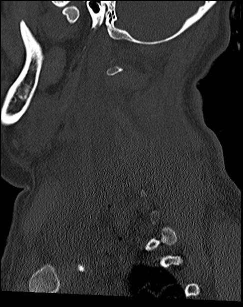 Atlanto-occipital dissociation - Traynelis type 1 (Radiopaedia 87570-103948 Sagittal bone window 62).jpg