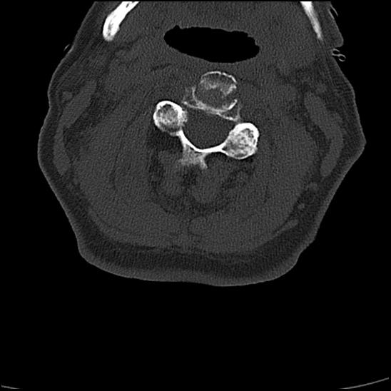 File:Atlas (type 3b subtype 1) and axis (Anderson and D'Alonzo type 3, Roy-Camille type 2) fractures (Radiopaedia 88043-104607 Axial bone window 30).jpg