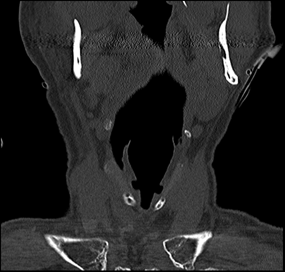 Atlas (type 3b subtype 1) and axis (Anderson and D'Alonzo type 3, Roy-Camille type 2) fractures (Radiopaedia 88043-104607 Coronal bone window 9).jpg