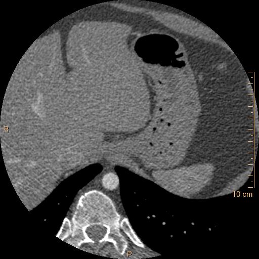 Atrial septal defect (upper sinus venosus type) with partial anomalous pulmonary venous return into superior vena cava (Radiopaedia 73228-83961 A 290).jpg