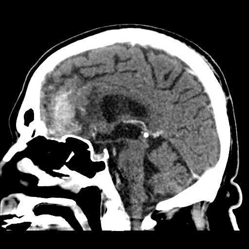 Atypical meningioma (WHO grade II) with brain invasion (Radiopaedia 57767-64728 Sagittal C+ 27).png