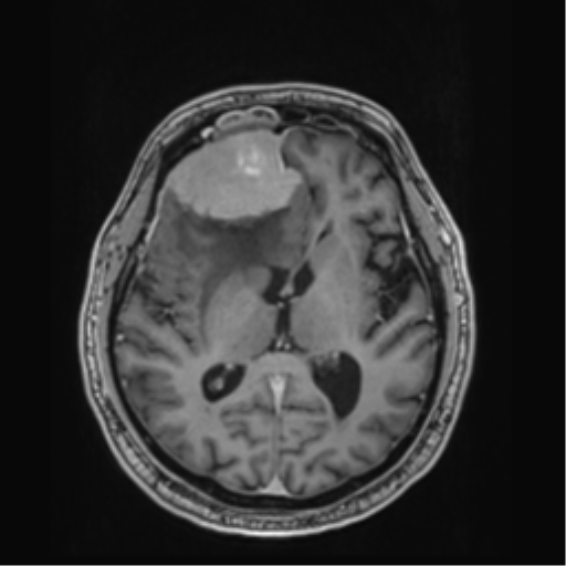 Atypical meningioma (WHO grade II) with brain invasion (Radiopaedia 57767-64729 Axial T1 C+ 25).png