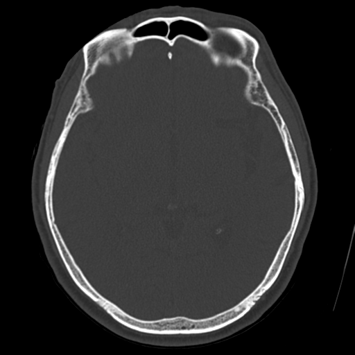 File:Atypical meningioma (WHO grade II) with osseous invasion (Radiopaedia 53654-59715 Axial bone window 39).png