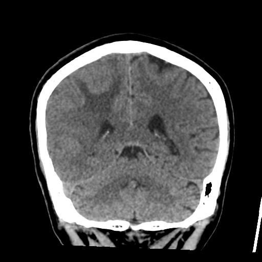 Atypical meningioma (WHO grade II) with osseous invasion (Radiopaedia 53654-59715 Coronal non-contrast 44).png