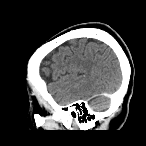 Atypical meningioma (WHO grade II) with osseous invasion (Radiopaedia 53654-59715 G 44).png