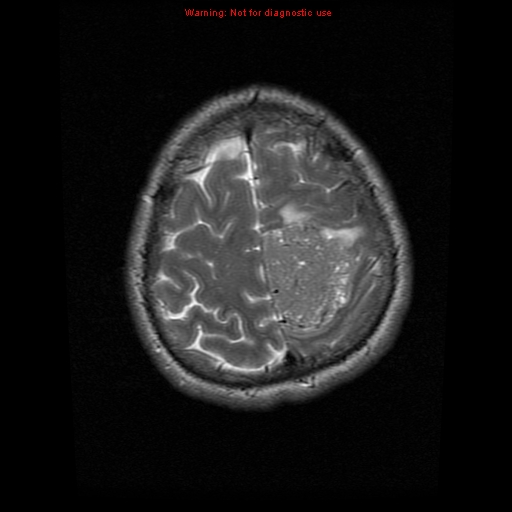 File:Atypical meningioma - grade II (Radiopaedia 13303-13305 Axial T2 19).jpg