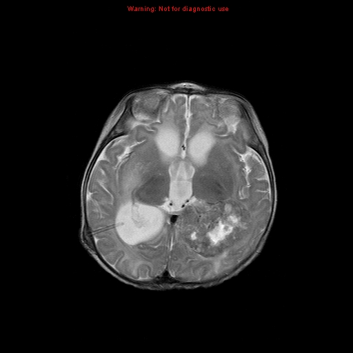 File:Atypical teratoid rhabdoid tumor (Radiopaedia 10712-11183 Axial T2 9).jpg