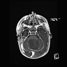 Atypical teratoid rhabdoid tumor (prenatal US and neonatal MRI) (Radiopaedia 59091-66388 Axial T1 C+ 18).jpg