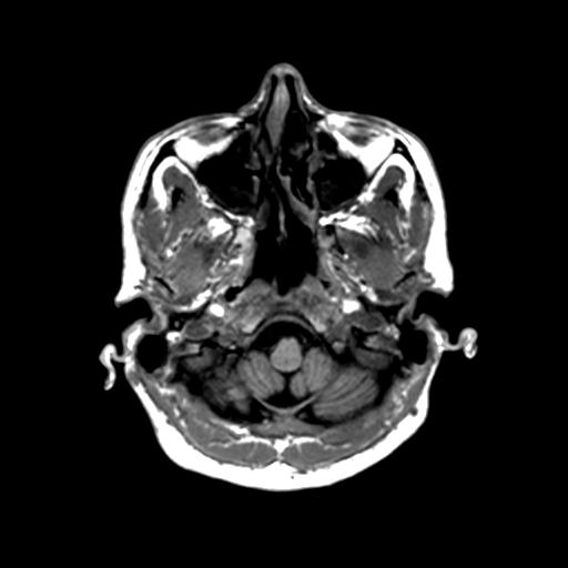 Autoimmune limbic encephalitis (Radiopaedia 30363-31005 T1 Axial 1mm 25).jpg