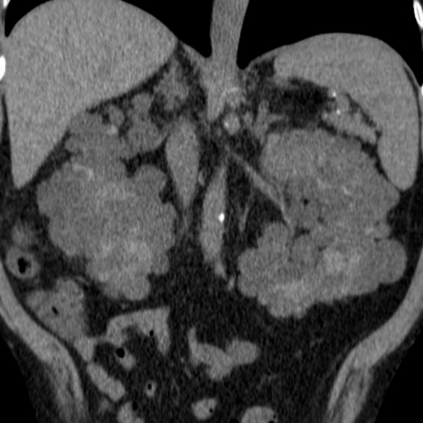 File:Autosomal dominant polycystic kidney disease (Radiopaedia 36539-38101 Coronal non-contrast 23).jpg