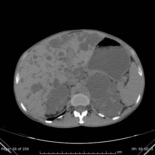 File:Autosomal dominant polycystic kidney disease (Radiopaedia 44122-47684 Axial 53).jpg