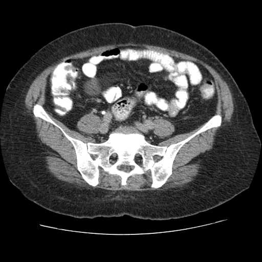 Autosomal dominant polycystic kidney disease with hepatic involvement (Radiopaedia 32693-33662 C 59).jpg