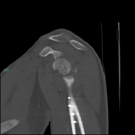 Avascular necrosis after fracture dislocations of the proximal humerus (Radiopaedia 88078-104653 Sagittal bone window 31).jpg
