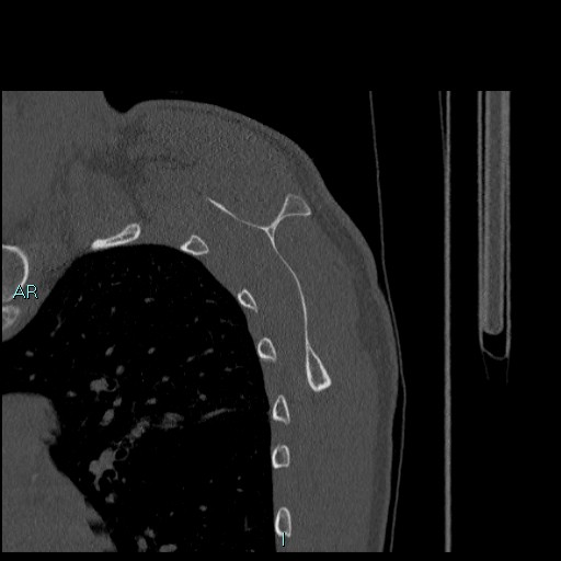 Avascular necrosis after fracture dislocations of the proximal humerus (Radiopaedia 88078-104655 Sagittal bone window 61).jpg