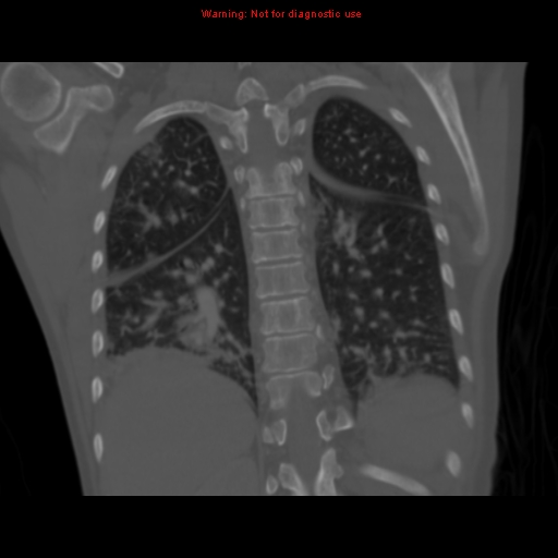 Avascular necrosis in sickle cell disease (Radiopaedia 17448-17152 Coronal bone window 94).jpg