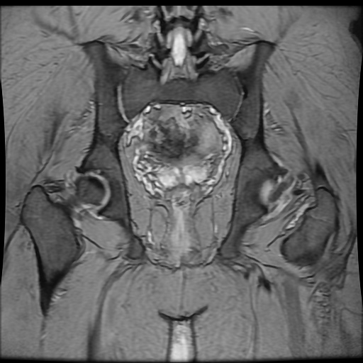 Avascular necrosis of the hip (Radiopaedia 61503-69465 F 67).jpg