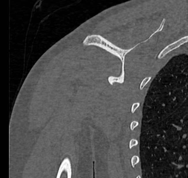 Avulsion fracture - greater tuberosity of humerus (Radiopaedia 71216-81514 Coronal bone window 51).jpg