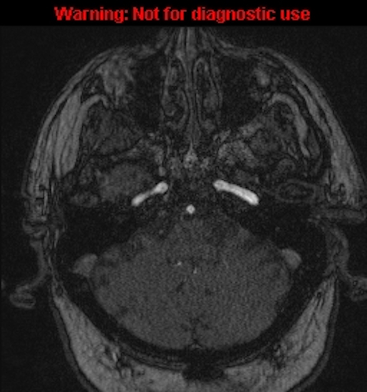 Azygos anterior cerebral artery (Radiopaedia 59325-66677 Axial MRA 29).jpg