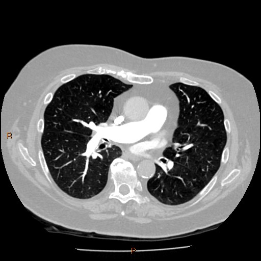 Azygos lobe (Radiopaedia 40161-42821 Axial lung window 36).jpg