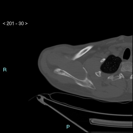 Bankart lesion with glenoid bone defect - assessment TC with PICO method (Radiopaedia 42855-93901 Axial bone window 29).jpg