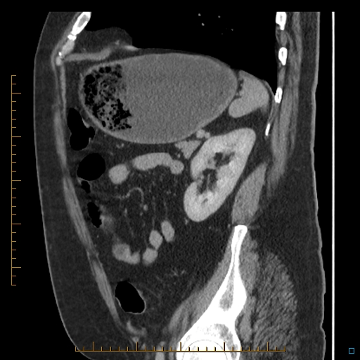 Bariatric balloon causing gastric outlet obstruction (Radiopaedia 54449-60672 C 23).jpg