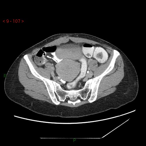 File:Bartholin gland cyst (Radiopaedia 54904-61181 Axial C+ delayed 27).jpg