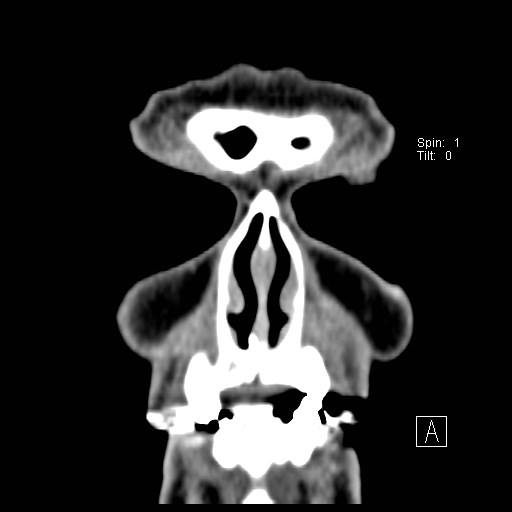 File:Basal cell carcinoma (periocular with orbital invasion) (Radiopaedia 30974-31672 Coronal Postcontrast 2).jpg
