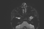 File:Basal cell carcinoma - nasal region (Radiopaedia 70292-80365 Axial DWI 27).jpg