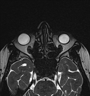Basal cell carcinoma - nasal region (Radiopaedia 70292-80365 Axial Gradient Echo 62).jpg