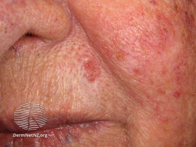 File:Basal cell carcinoma affecting the face (DermNet NZ lesions-bcc-face-0807).jpg