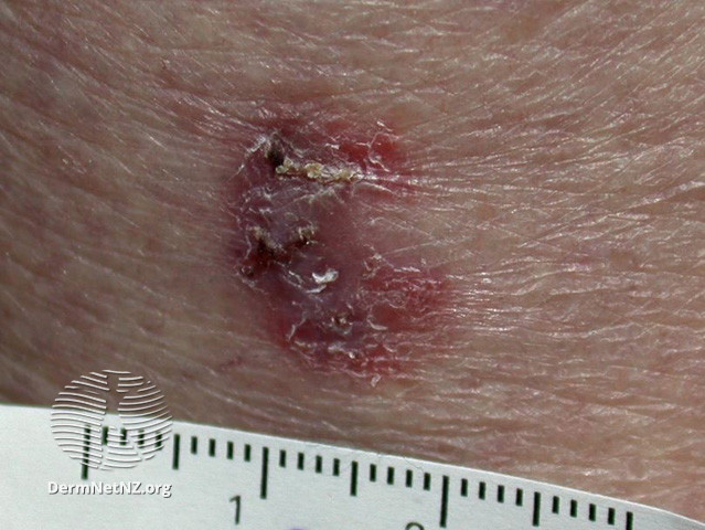 File:Basal cell carcinoma affecting the trunk (DermNet NZ lesions-bcc-trunk-0916).jpg