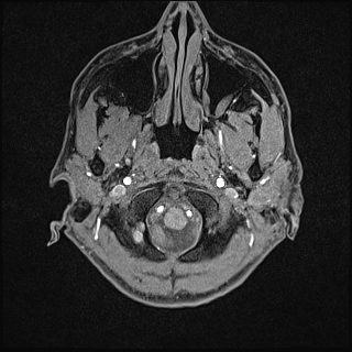 Basilar artery perforator aneurysm (Radiopaedia 82455-97733 Axial T1 fat sat 4).jpg