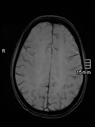 Basilar artery perforator aneurysm (Radiopaedia 82455-99523 Axial SWI 45).jpg