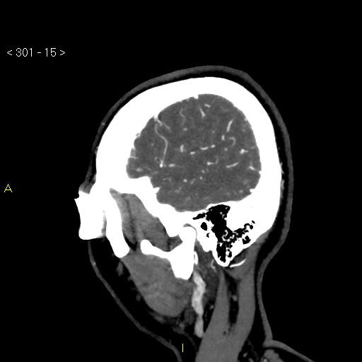 File:Basilar artery thrombosis (Radiopaedia 16260-15944 C 9).jpg