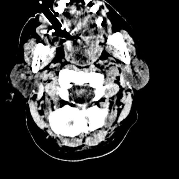 Basilar artery thrombosis (Radiopaedia 53351-59333 Axial non-contrast 13).jpg