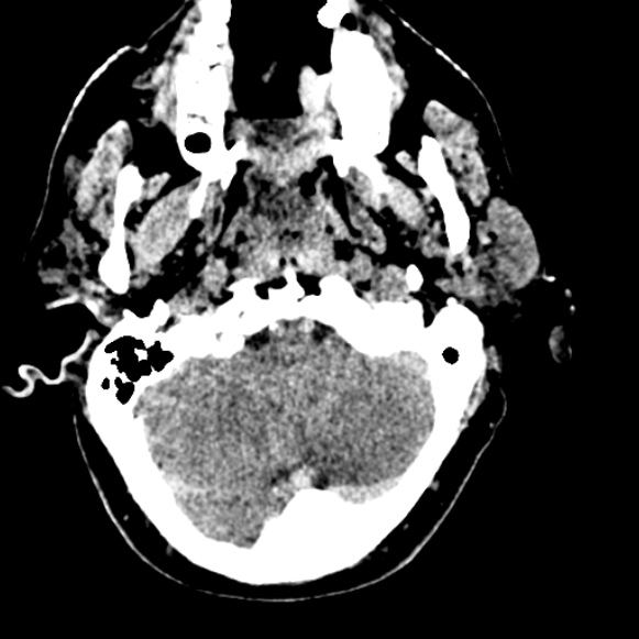 Basilar artery thrombosis (Radiopaedia 53351-59333 Axial non-contrast 27).jpg