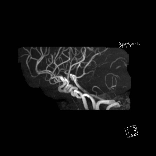 Basilar tip aneurysm (Radiopaedia 26504-26632 D 50).jpg